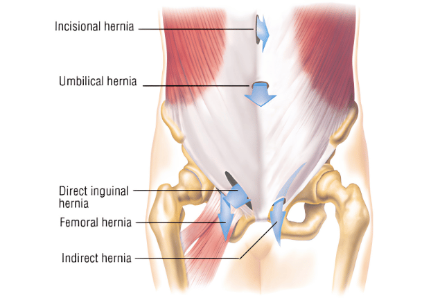 Diagram of abdominal hernia locations